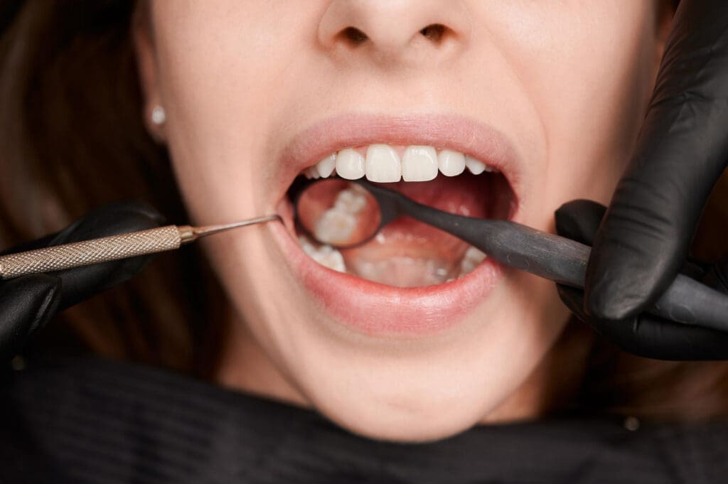 What Happens When You Ignore a Cavity? The Hidden Risks of Untreated Tooth Decay