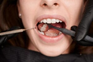 What Happens When You Ignore a Cavity? The Hidden Risks of Untreated Tooth Decay